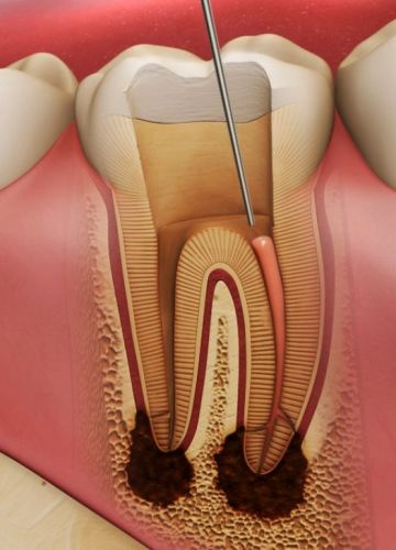 Endodontija jeb sakņu kanālu ārstēšana