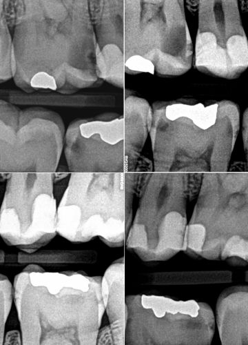 Diagnostika: intraorālais digitālais rentgens