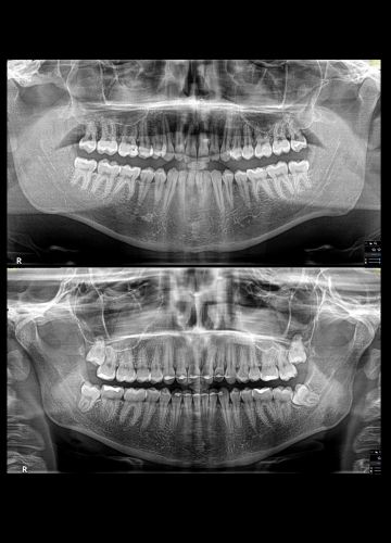 Diagnostika: panorāmas (OPG) rentgena izmeklējums