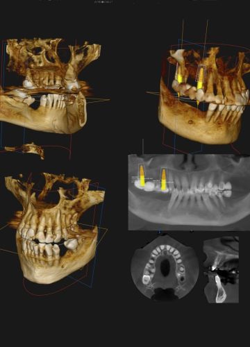 Diagnostika: 3D datortomogrāfija