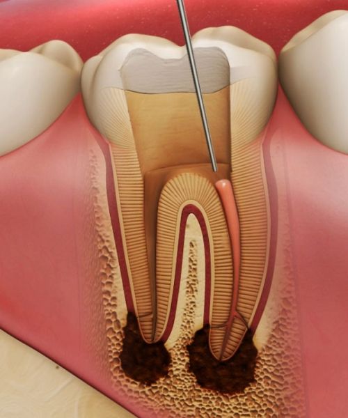 Endodontija jeb sakņu kanālu ārstēšana
