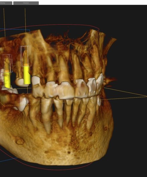 Diagnostika: 3D datortomogrāfija