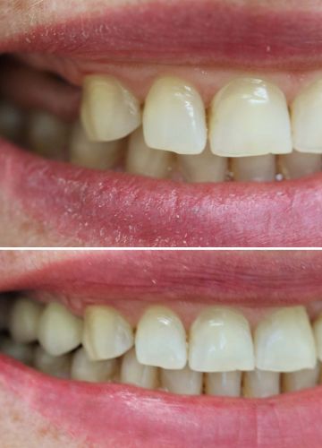 Metālkeramikas tilts + 2 zoba implanti