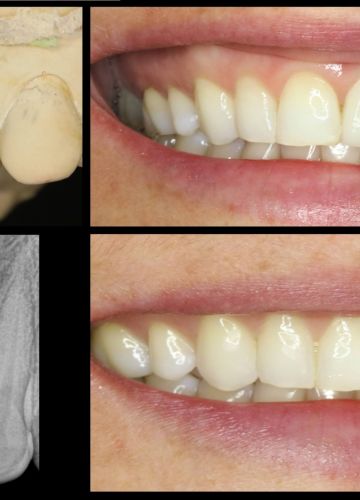 Slāņots cirkonija keramikas kronis  + zoba implants