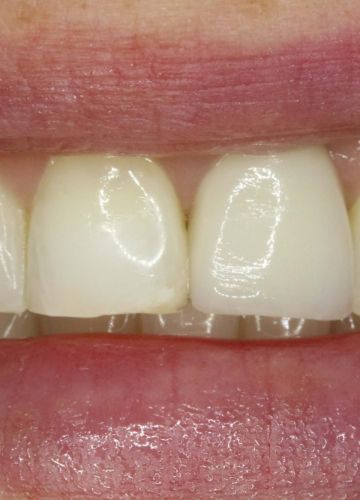 Slāņots cirkonija keramikas kronis  + zoba implants
