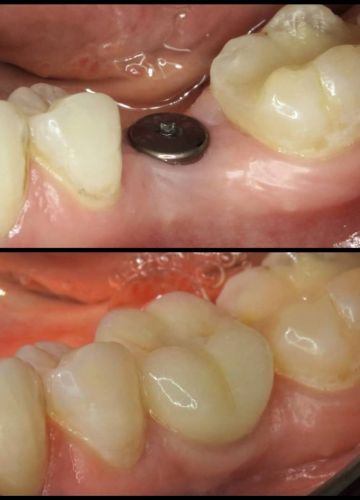 Straumann zoba implants + slāņots cirkonijkeramikas kronis