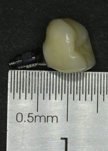 Straumann zoba implants + slāņots cirkonijkeramikas kronis