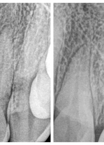 Slāņots cirkonija keramikas kronis  + zoba implants