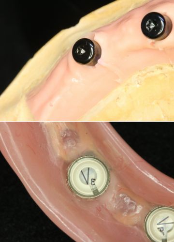 uz 4 implantiem balstīta apakšžokļa protēze (izņemama)