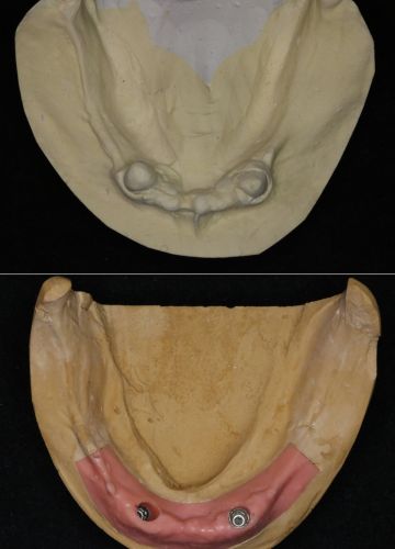 Uz 2 implantiem balstīta izņemamā protēze (akrila)
