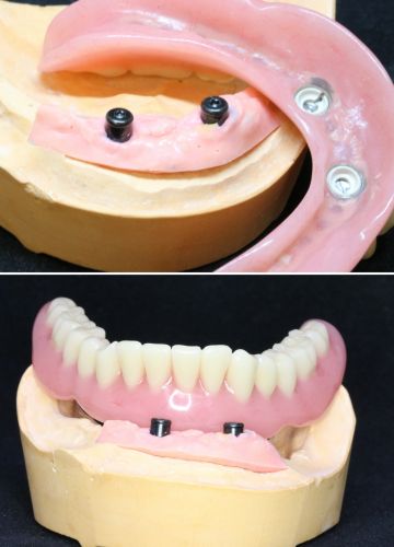 Uz 2 implantiem balstīta izņemamā protēze (akrila) (2)