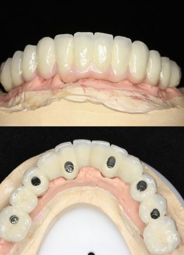 Apakšžokļa visu zobu atjaunošana  - 6 implanti+ metālkeramikas konstrukcija
