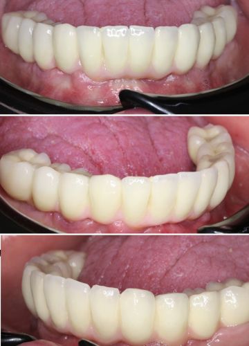 Apakšžokļa visu zobu atjaunošana  - 6 implanti+ metālkeramikas konstrukcija