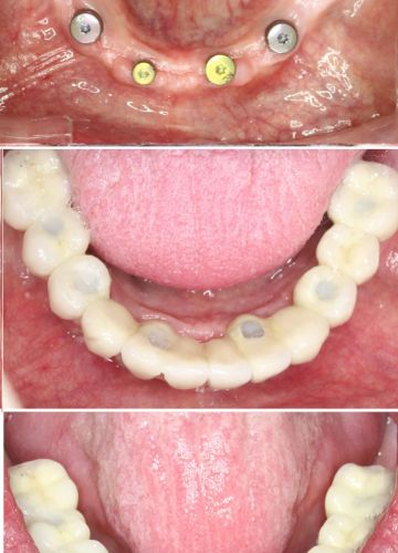 Apakšžokļa visu zobu atjaunošana  - 6 implanti+ metālkeramikas konstrukcija