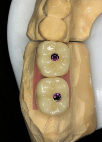 2 implanti + pilnas formas cirkonija oksīda kroņi