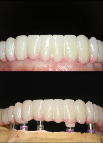 Apakšžokļa visu zobu atjaunošana - 6 implanti + cirkonijoksīda konstrukcija