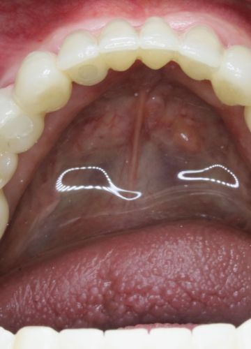 Apakšžokļa visu zobu atjaunošana - 6 implanti + cirkonijoksīda konstrukcija