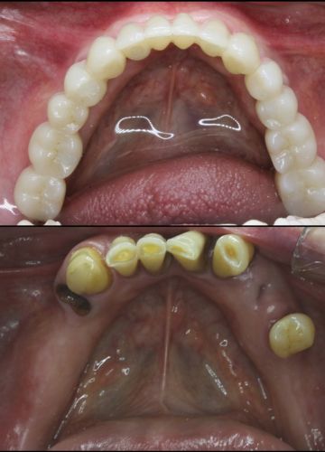 Apakšžokļa visu zobu atjaunošana - 6 implanti + cirkonijoksīda konstrukcija