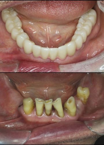 Apakšžokļa visu zobu atjaunošana - 6 implanti + cirkonijoksīda konstrukcija