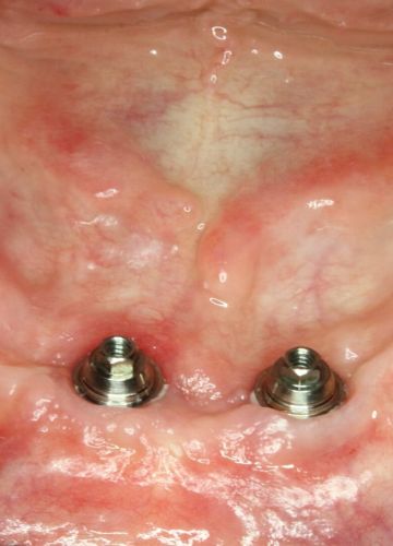 Apakšžokļa zobu atjaunošana - 4 implanti + cirkonija konstrukcija
