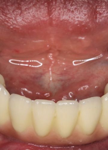 Apakšžokļa zobu atjaunošana - 4 implanti + cirkonija konstrukcija