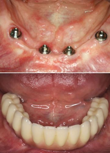 Apakšžokļa zobu atjaunošana - 4 implanti + cirkonija konstrukcija