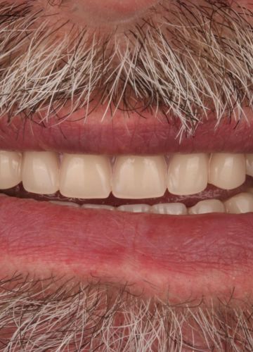 Augšžokļa un apakšžokļa visu zobu atjaunošana ar zobu implantiem