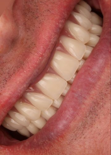 Abu žokļu zobu pilnīga atjaunoāna ar 9 zobu implantiem + pagaidu protēzēm (šis darbs vēl nav pabeigts)