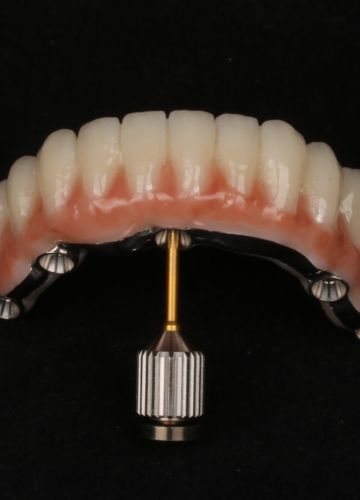 Apakšžokļa visu zobu atjaunošana + augšžoklī totālā protēze