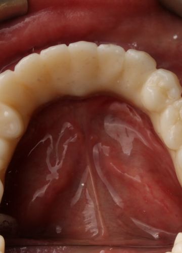 Apakšžokļa visu zobu atjaunošana + augšžoklī totālā protēze