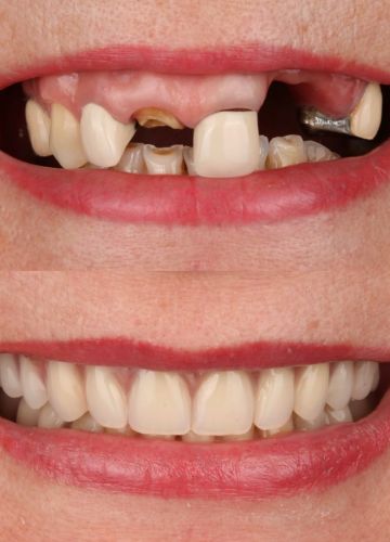 Augšžokļa visu zobu atjaunoša ( 4implanti + pagaidu protēze)