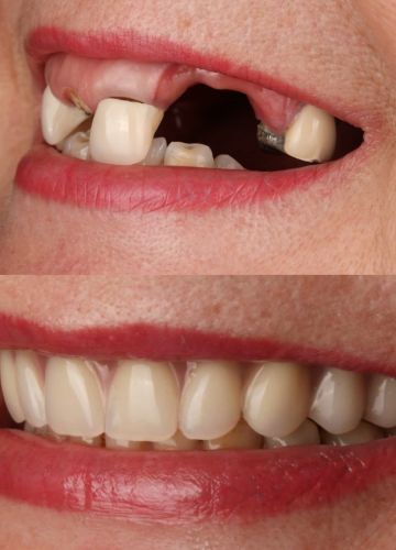 Augšžokļa visu zobu atjaunoša ( 4implanti + pagaidu protēze)
