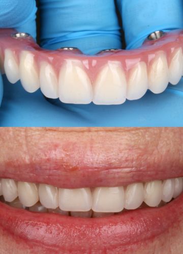Augšžokļa visu zobu atjaunošana  ( 4 implanti + pagaidu protēze)