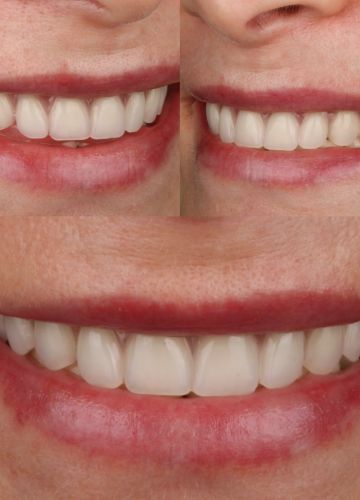 Augšžokļa visu zobu atjaunošana ( 6 implanti + konstrukcija)