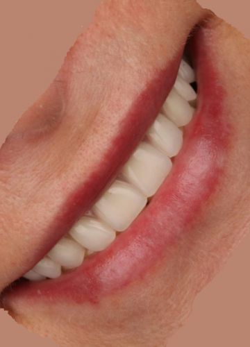 Augšžokļa visu zobu atjaunošana ( 6 implanti + konstrukcija)
