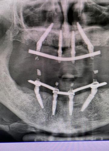Implantu ķirurģijas kursi Bragā, Portugālē 09.2022