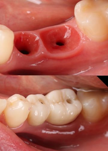 Divu neatjaunojamu zobu aizvietošana ar implantiem un cirkonija kroņiem (2)