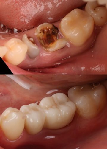Divu neatjaunojamu zobu aizvietošana ar implantiem un cirkonija kroņiem (2)