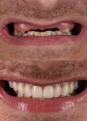 Augšžokļa zobu rindas atjaunošana - 6 implanti un tūlīteja akrila-titāna konstrukcija