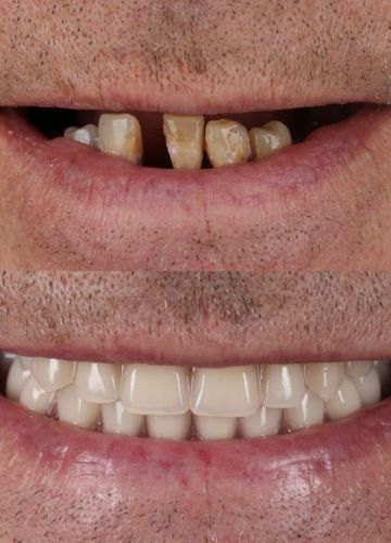 Abu žokļu rindu atjaunošana - 12 implanti un tūlītēja protezēšana