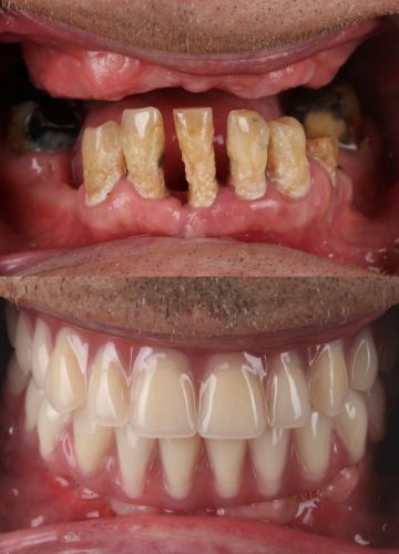 Abu žokļu atjaunošana - 12 implanti un tūlītēja protezēšana