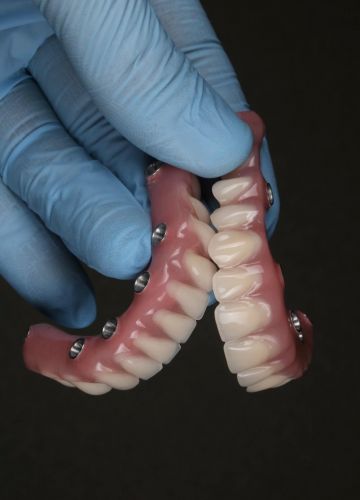 Abu žokļu atjaunošana - 12 implanti un tūlītēja protezēšana