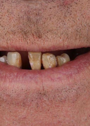 Abu žokļu atjaunošana - 12 implanti un tūlītēja protezēšana