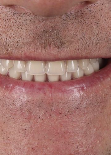 Abu žokļu atjaunošana - 12 implanti un tūlītēja protezēšana