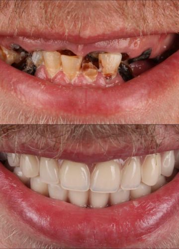 Abu žokļa zobu rindu atjaunošana