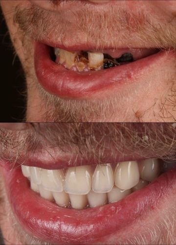 Abu žokļa zobu rindu atjaunošana