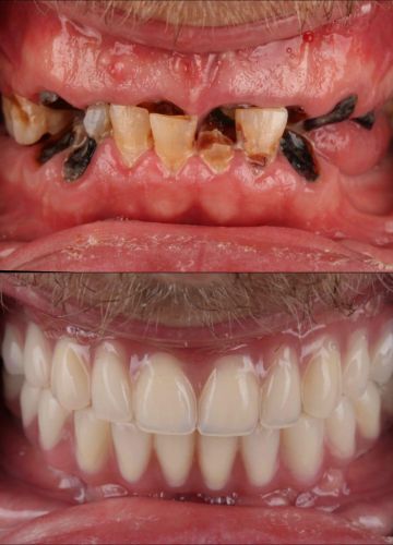 Abu žokļa zobu rindu atjaunošana