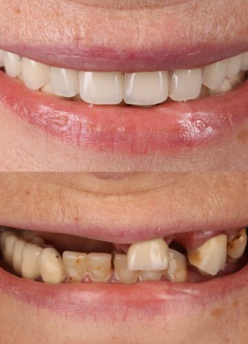 Augšžokļa  ''all on 4''