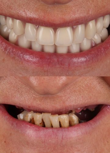 Abu žokļu zobu rindas atjaunošana ar implantiem un fiksētām konstrukcijām