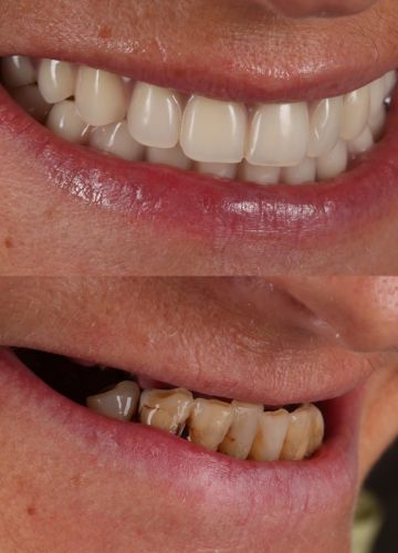 Abu žokļu zobu rindas atjaunošana ar implantiem un fiksētām konstrukcijām